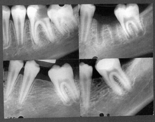 Nhổ răng 6 (răng cối lớn vĩnh viễn thứ nhất) không thể phục hồi khi nào ? nvcshare