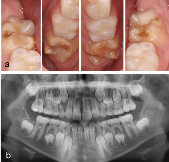 Nhổ răng 6 (răng cối lớn vĩnh viễn thứ nhất) không thể phục hồi khi nào ? nvcshare