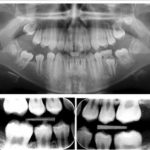 Nhổ răng 6 (răng cối lớn vĩnh viễn thứ nhất) không thể phục hồi khi nào (4)