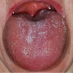 kho-mieng-la-gi-chan-doan-nguyen-nha-va-dieu-tri-nvchsare-Erythematous tongue-cadida
