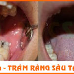 TRA-RANG-Hôi-miệng-có-phải-là-biểu-hiện-của-bệnh-lý-răng-miệng-nguy-hiểm-nvcshare-bs-cuong-nha-khoa-lam-rang-